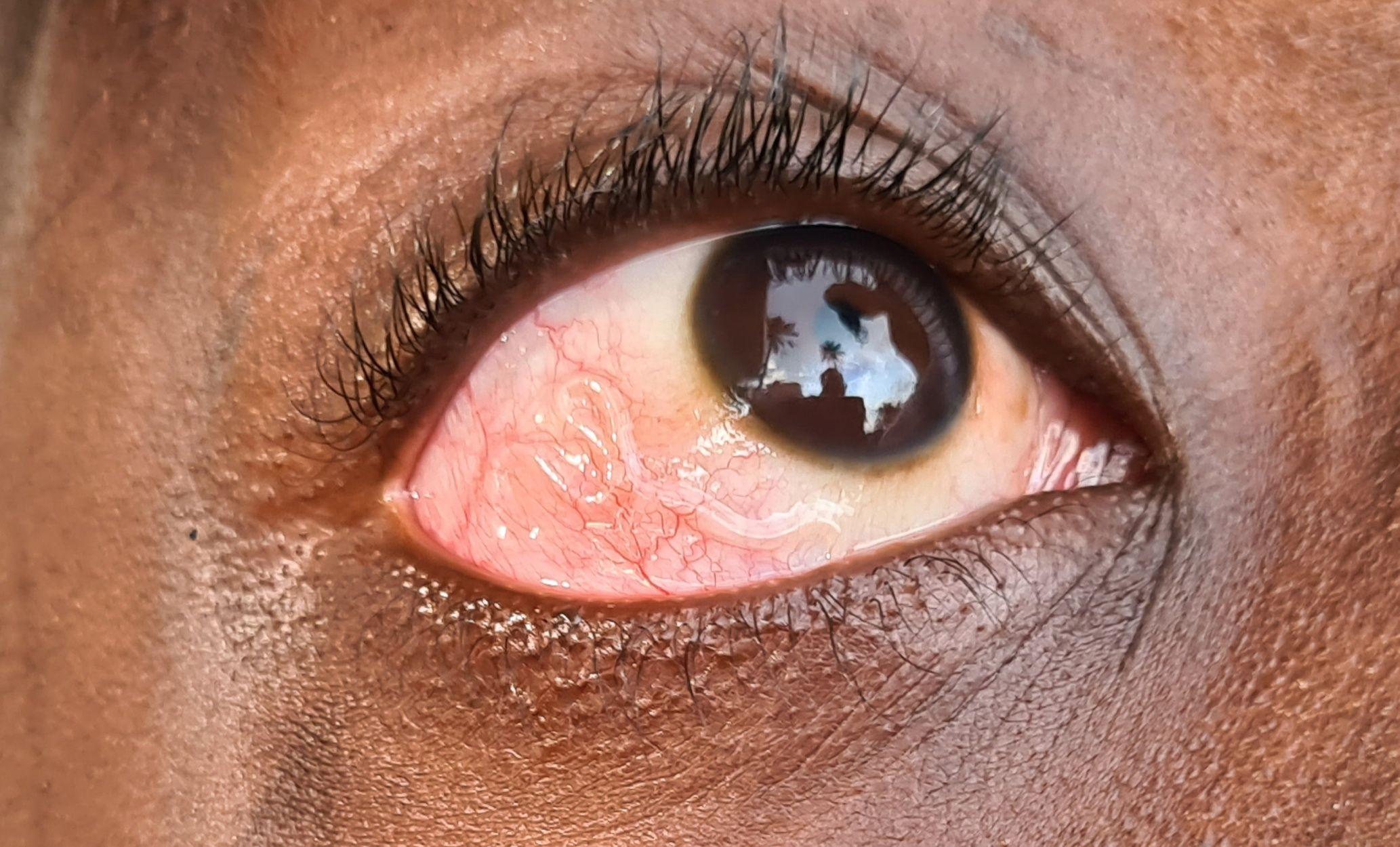 Pciture of an with the worm infected eye. A wormis clearly visibly on the eyeball.